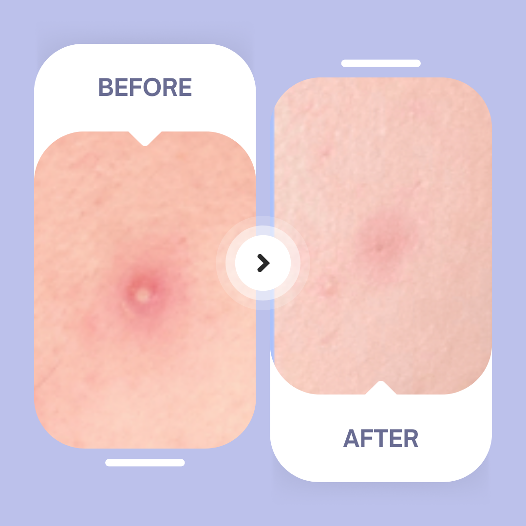 Spotted Nighttime - Original Hydrocolloid Patches